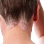 Psoriasis.webp